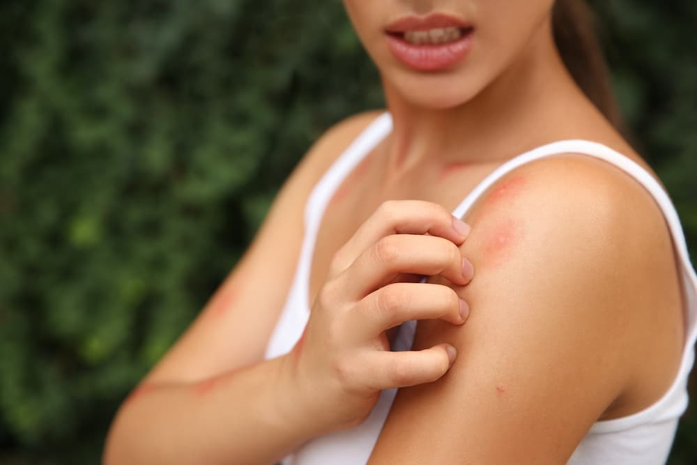 Identifying Bug Bites: Understanding Different Reactions
