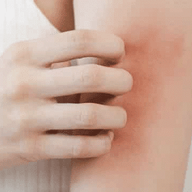 Treatment-Dermatitis